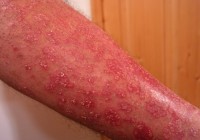 Hranice pre liečbu psoriázy sa posúvajú. Nová biologická liečba je dostupná už aj na Slovensku.