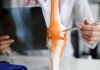Čo je dobré vedieť o artróze kĺbov?